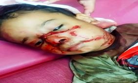 حمله سگ‌های ولگرد به کودک ۴ ساله در خوزستان