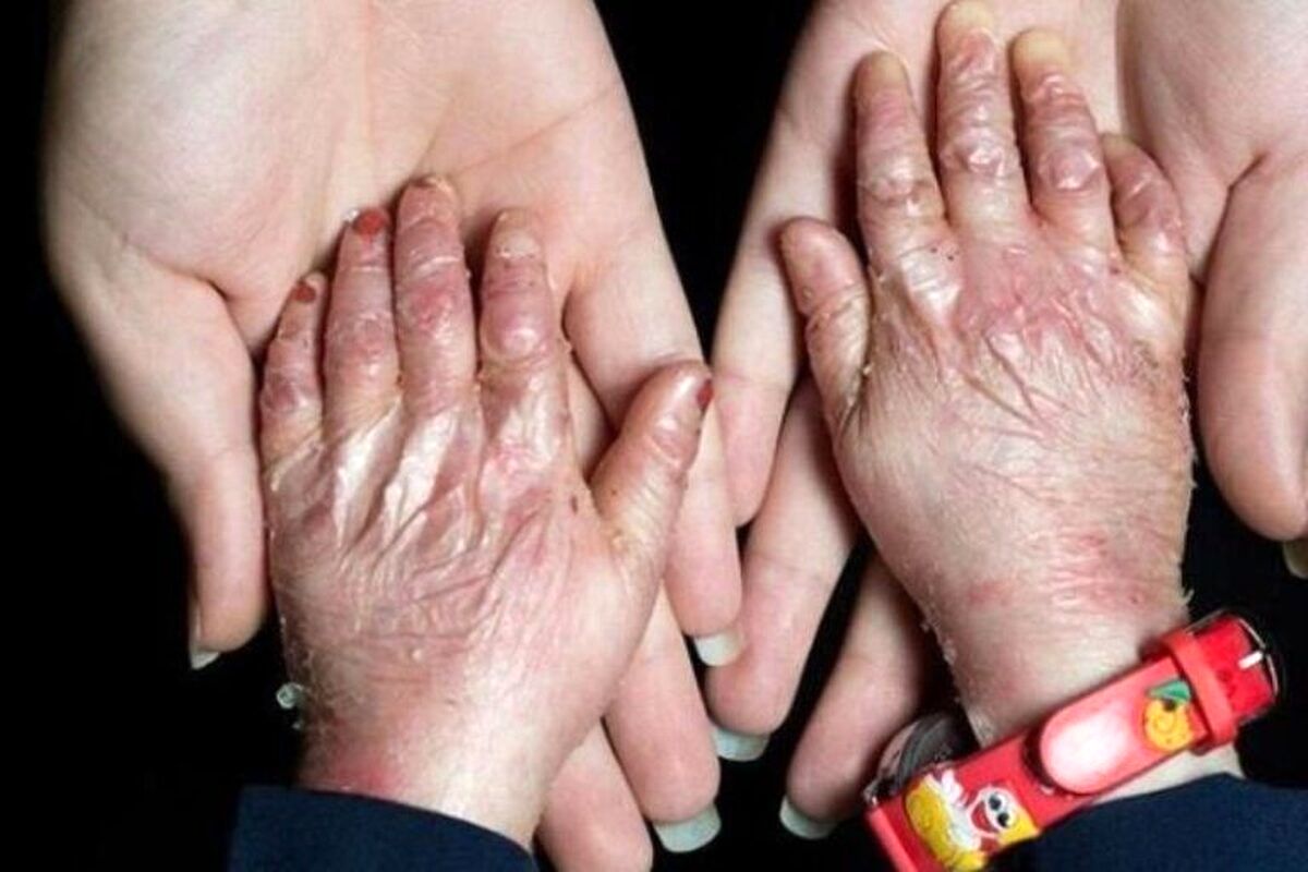 بیماری پروانه ای نتیجه جهش ژن در ازدواج های فامیلی است