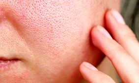 اگر پوست چرب دارید این توصیه‌ها را جدی بگیرید