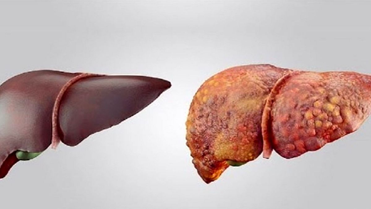 ارتباط عارضه کبد چرب با نارسایی قلبی