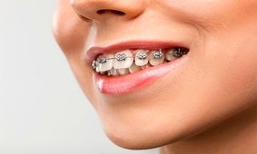 ارتودنسی چیست و چه مراحلی دارد؟ (همراه با عکس مراحل ارتودنسی)