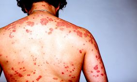 علائم اولیه HIV با سرماخوردگی چه تفاوت هایی دارد؟
