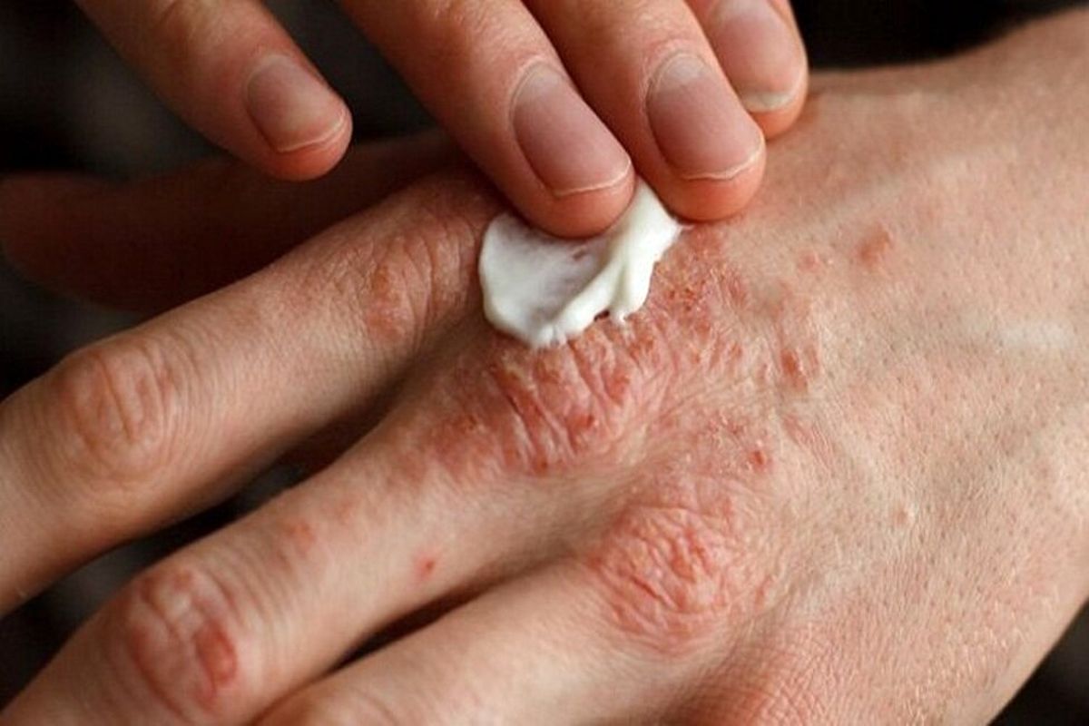 دیابت چگونه بر پوست تاثیر می‌گذارد؟