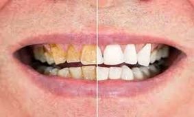 فرمول‌های ساده برای جلوگیری از پوسیدگی دندان + غذاهای مضر برای سلامت دندان