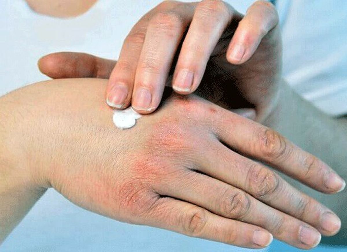 چگونه از پوست خود در روزهای کرونایی مراقبت کنیم؟