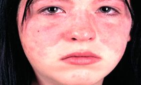 چگونه لوپوس روی چشمان شما اثر می‌گذارد؟