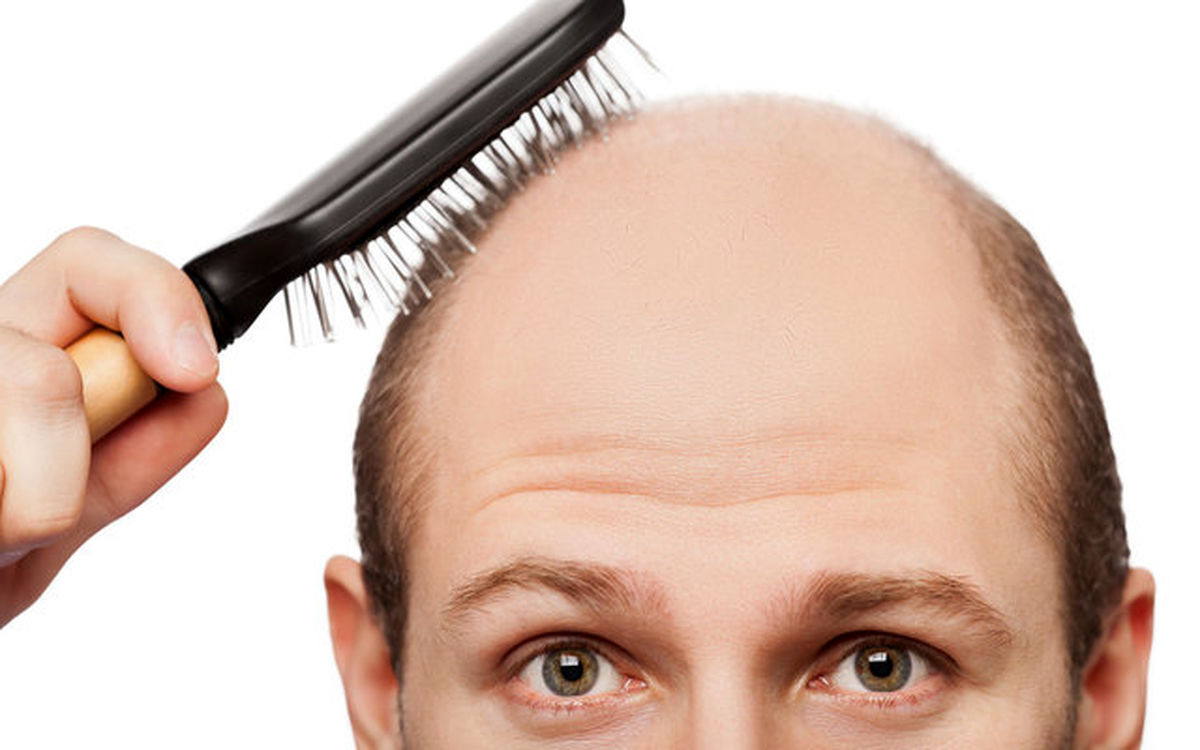 راه مقابله با کچلی چیست؟