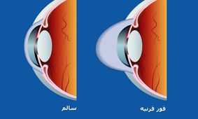 قوز قرنیه را با آستیگمات اشتباه نگیریم