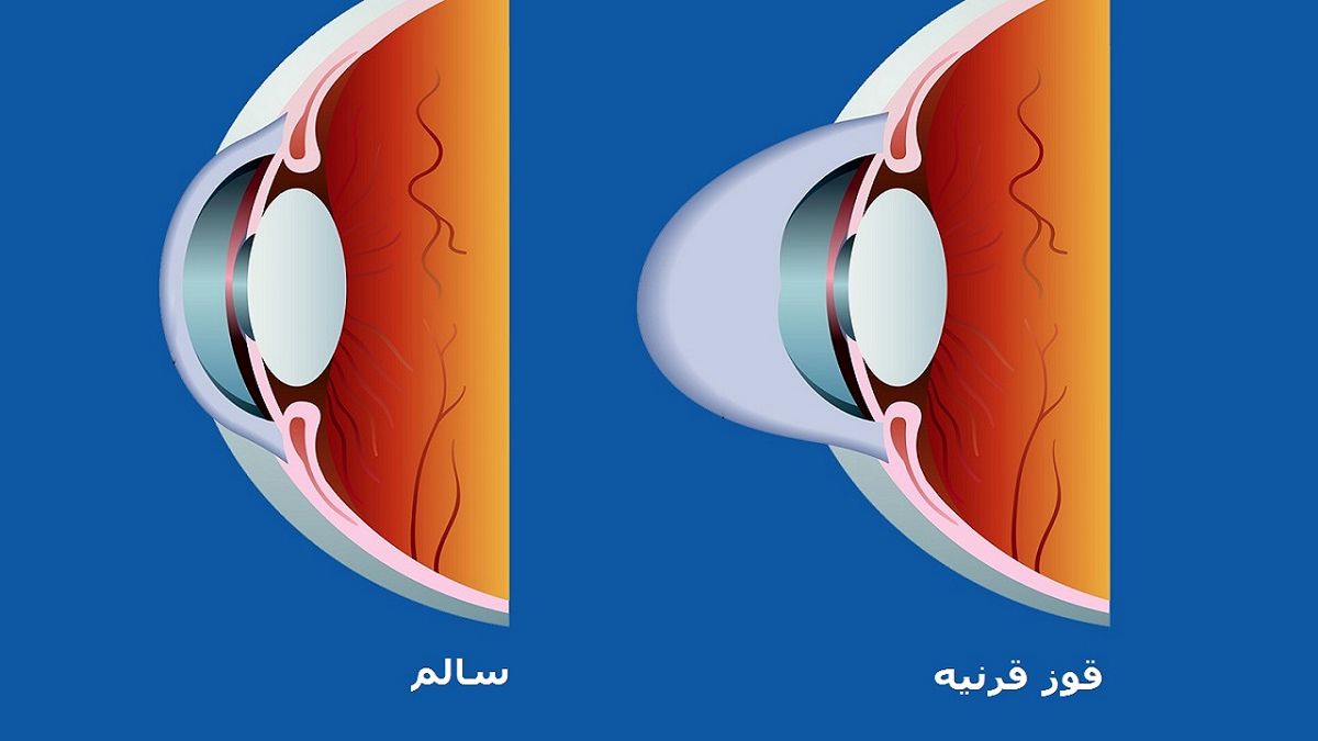 قوز قرنیه را با آستیگمات اشتباه نگیریم