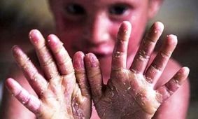 تجمع خانواده‌های کودکان "پروانه‌ای"