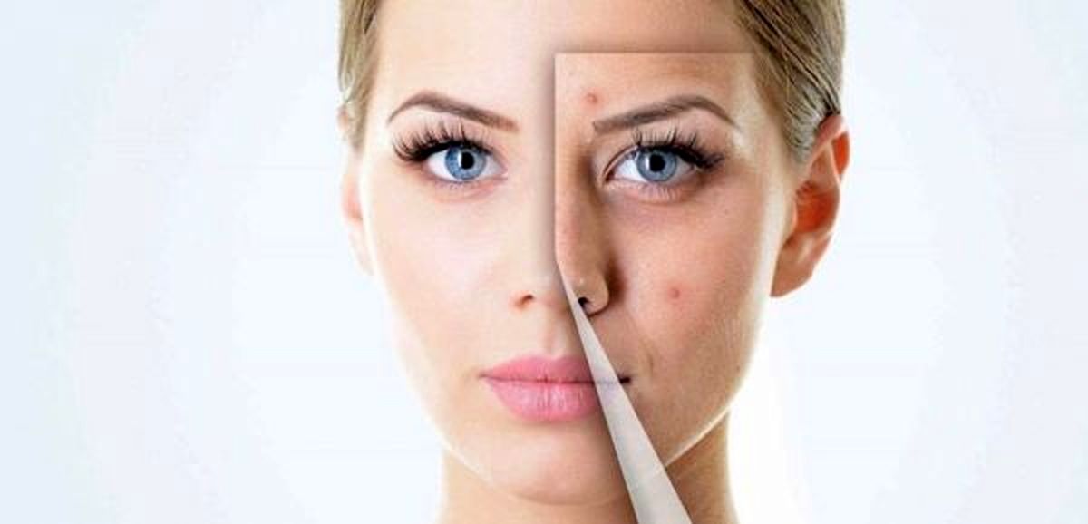 با این مواد طبیعی از شر جای جوش خلاص شوید