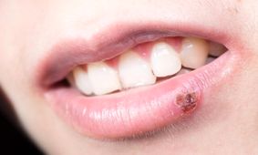 ارتباط میان تب خال و بیماری های تخریب کننده سلول‌های عصبی