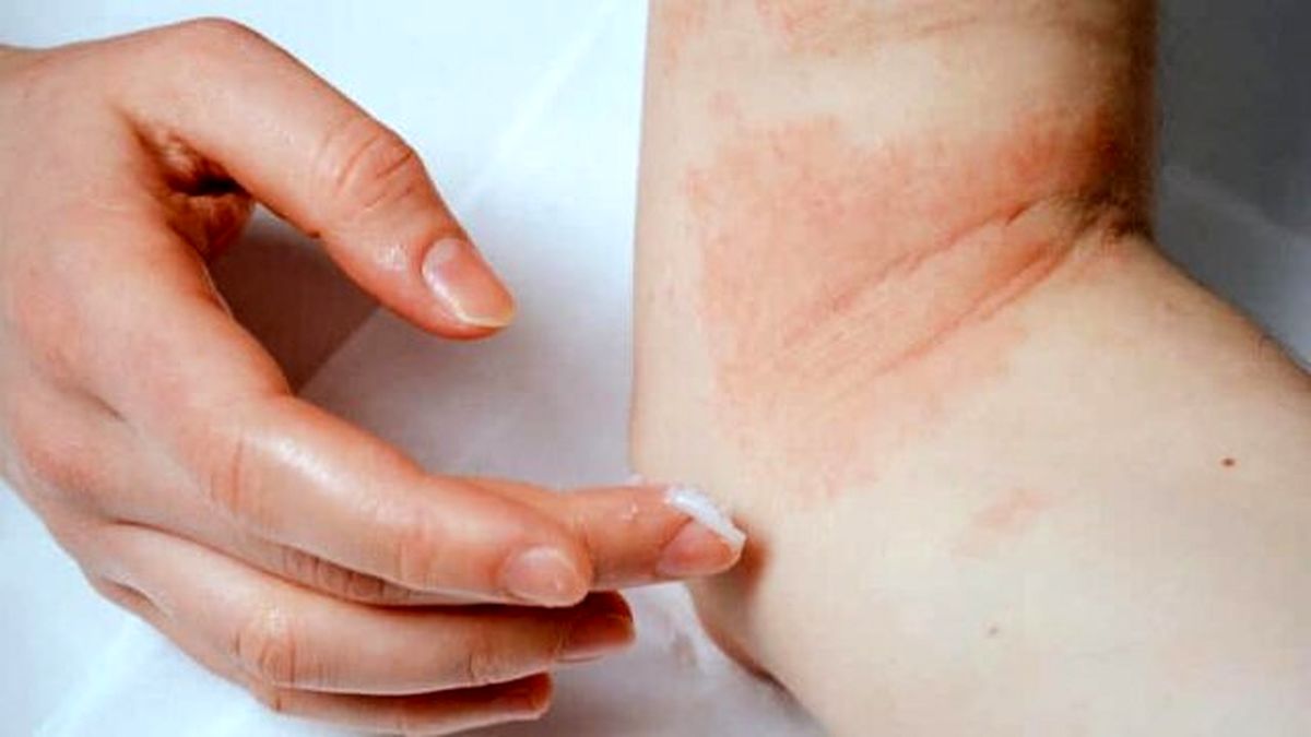 نقش هورمون‌های جنسی در ایجاد اگزما