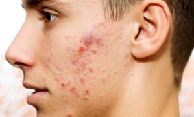 غذاهایی که باعث جوش صورت و آکنه میشود