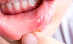علل بروز آفت دهان و روش‌های درمان آن