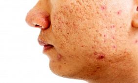 جای جوش با لیزر کاملا رفع می‌شود؟