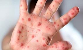 شناسایی ۷۰ بیمار مبتلا به سرخک در هرمزگان