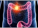 پیشگیری از سرطان روده بزرگ با راهکاری ساده