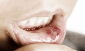 چه نوع زخمی از نشانه های سرطان دهان است؟