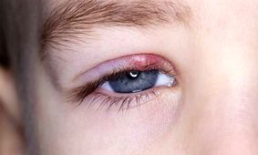 چگونه گل مژه را از بین ببریم؟