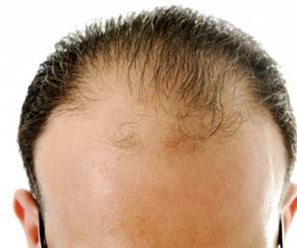 جلوگیری از ریزش مو