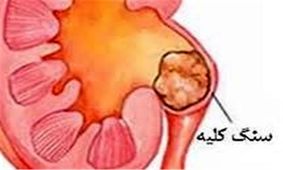 همه چیز درباره سنگ کلیه