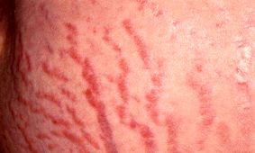 علل خارش ترک های بارداری چیست و چگونه از آن پیشگیری کنید؟
