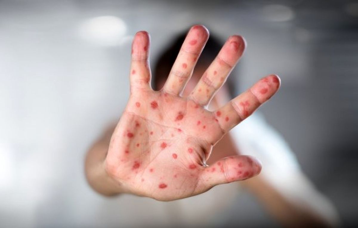 علائم "سرخک" و اهمیت واکسیناسیون کودکان در موعد مقرر