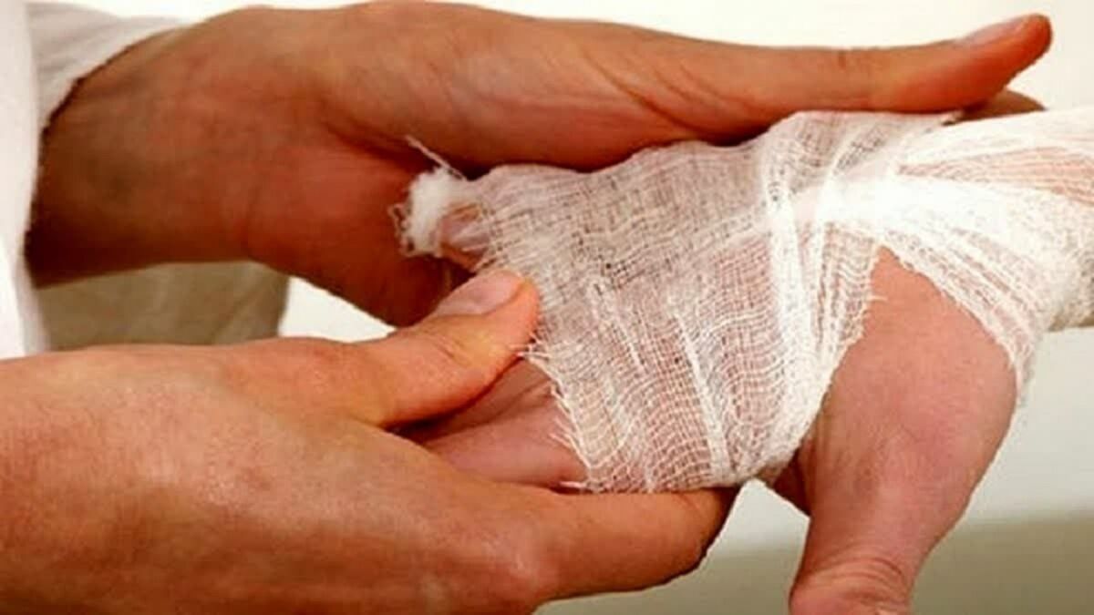 انفجار مواد محترقه و قطع انگشتان نوجوان همدانی