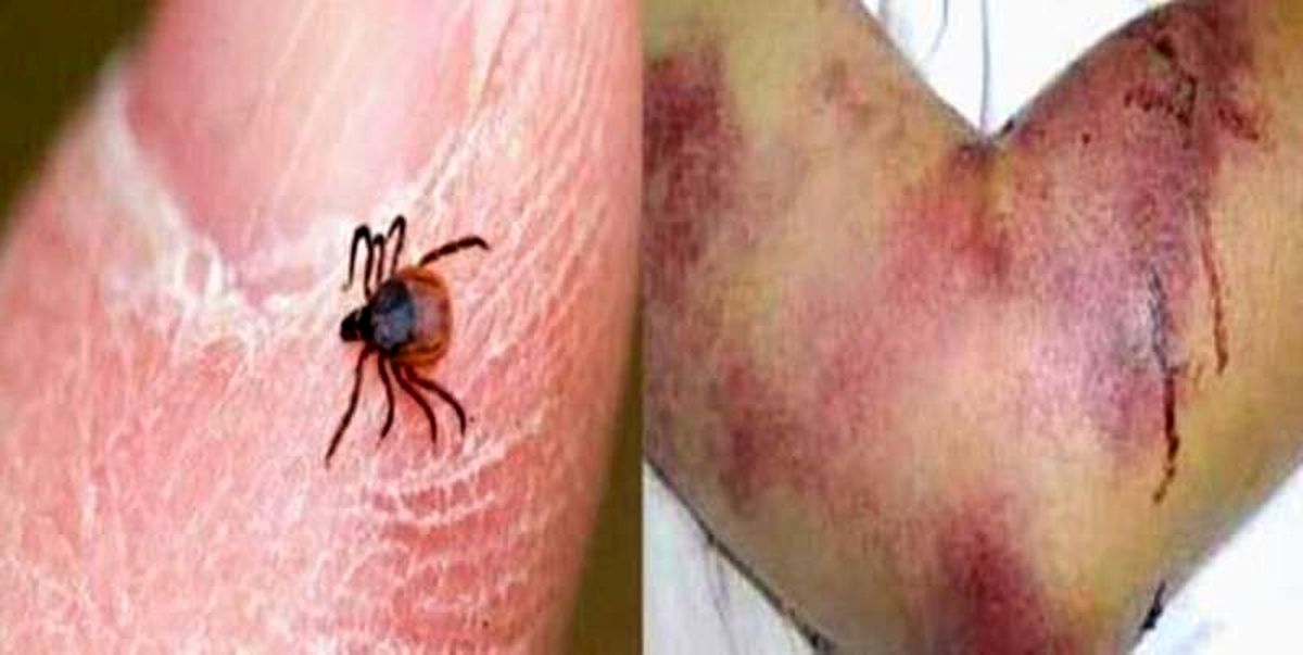 ابتلای یک مورد از ۶ فرد مشکوک به ابتلاء تب کریمه کنگو در یزد تایید شد