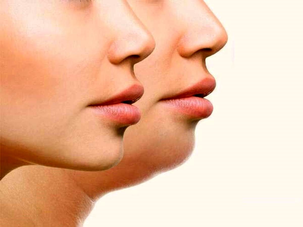 راه‌هایی برای چاق‌شدن صورت