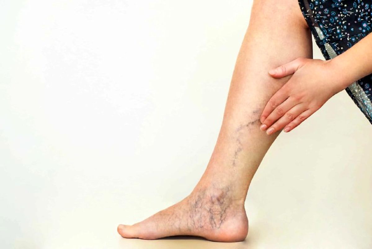 چرا واریس خطرناک است؟