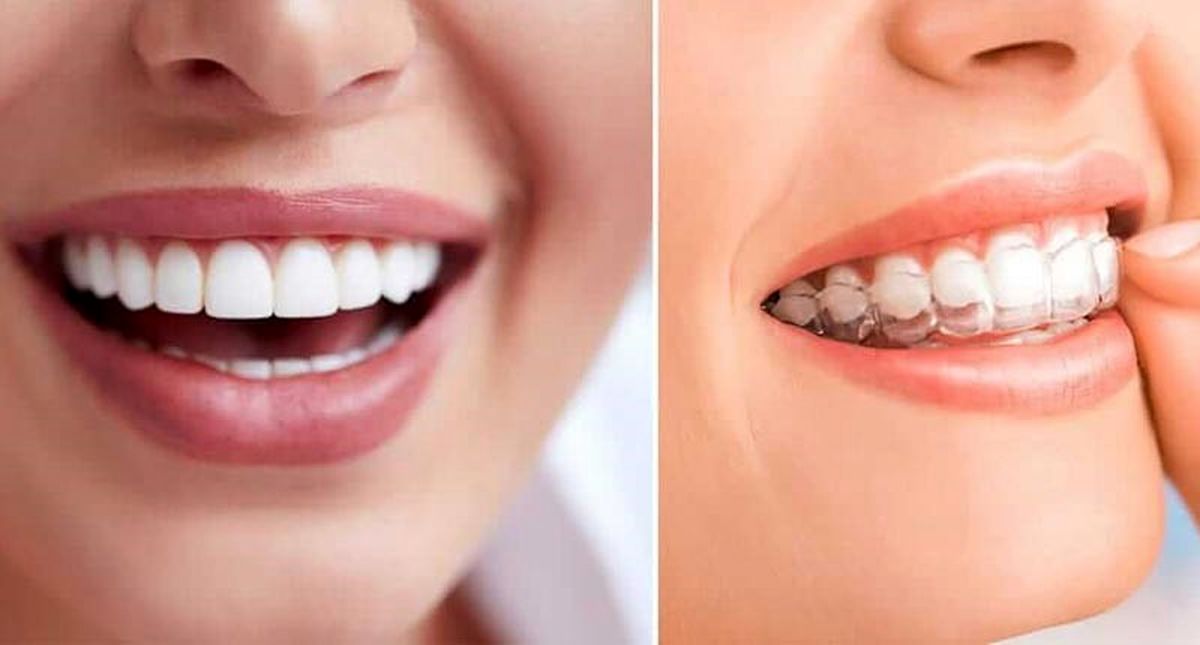 9 مزیت بزرگ ارتودنسی نامرئی نسبت به ارتودنسی های دیگر