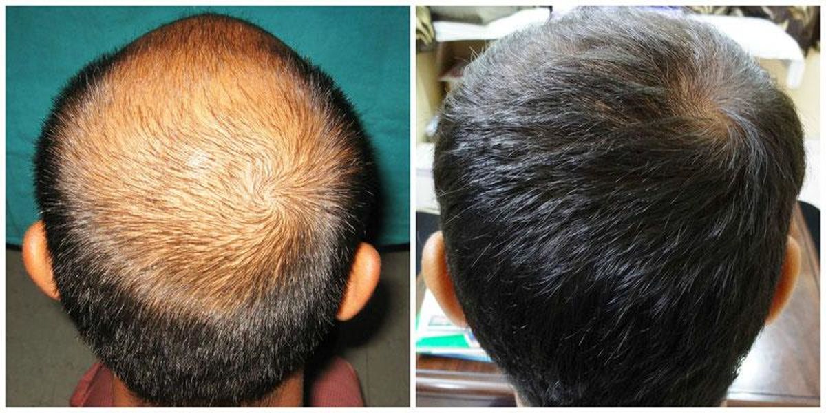 آیا فرد دیابتی می‌تواند کاشت مو انجام دهد؟